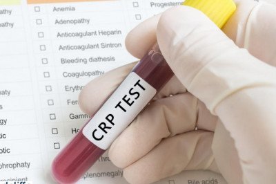 CRP Test in Bangalore @360/- | Redcliffe Labs