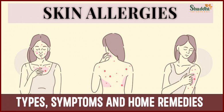 Skin Allergies : Types, Symptoms and Home Remedies
