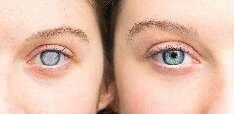 Arizona Cataract Surgery
