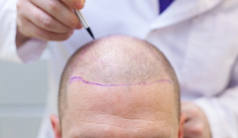 Hair Transplant in Panipat