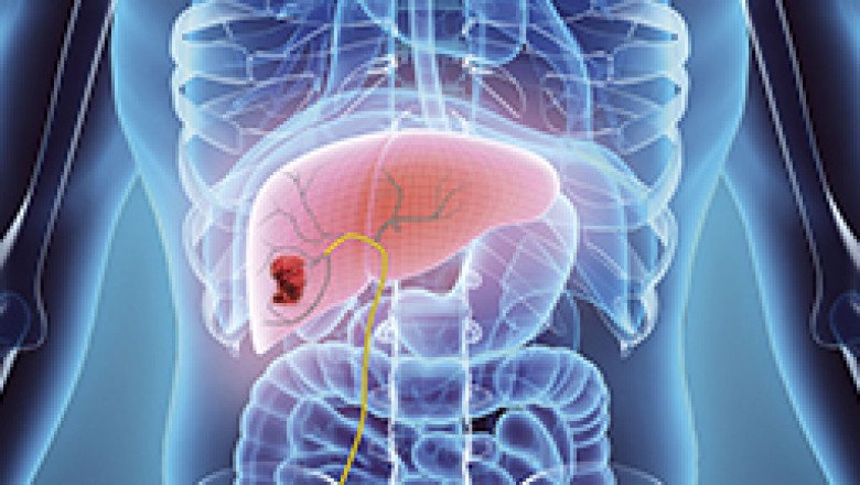 Liver cancer treatment in India