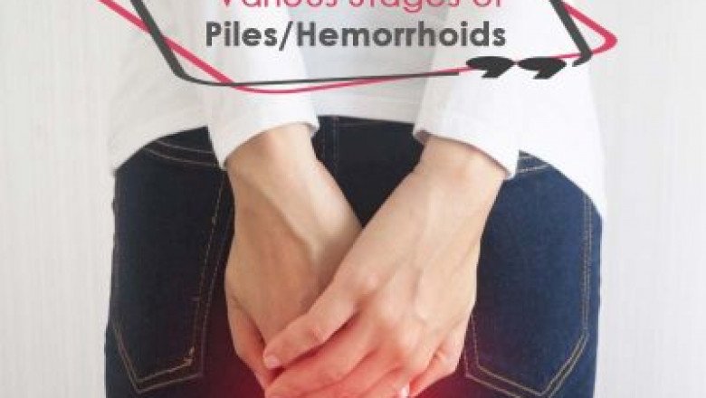 Types of Hemorrhoids