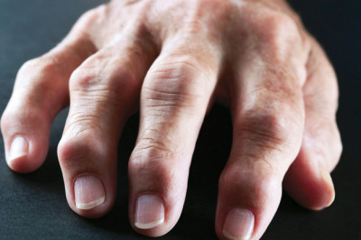 Arthritis Management