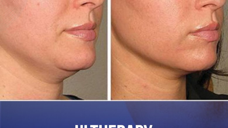 Ultherapy Treatment In Bangalore | Ultherapy Cost In Bangalore | Kosmoderma