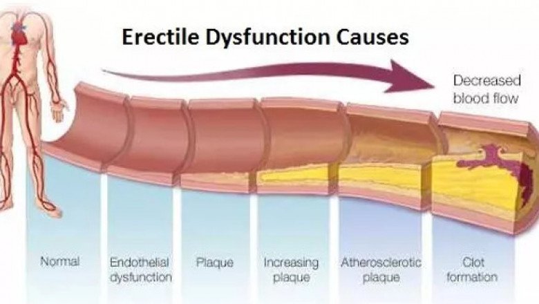 Can a swollen prostate cause erectile dysfunction