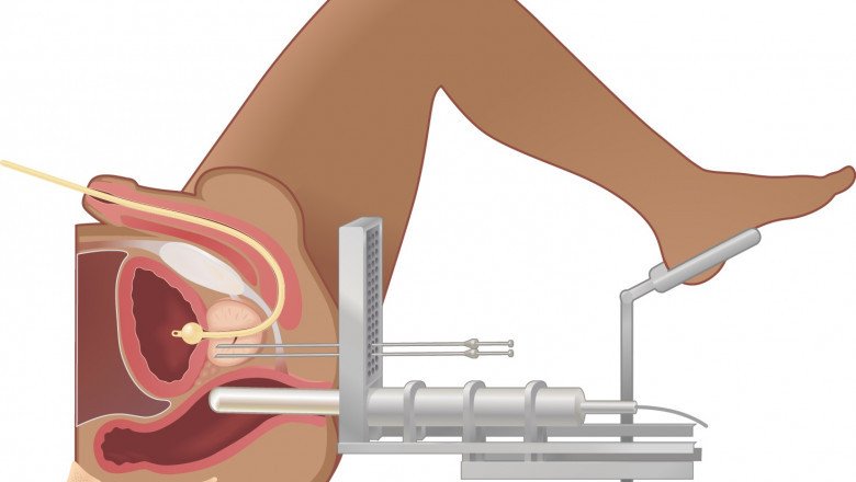 With Brachytherapy, Radioactive Material Is Implanted Directly Into The Body Using A Needle Or Catheter