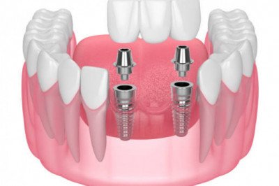 Different Types of Dental Implant Restorations