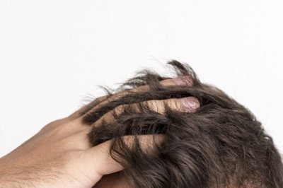 Best Hair Loss Treatment in Hyderabad - FMS Skin and Hair Clinic