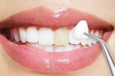 San Diego Teeth Whitening - Choosing the Best Way to Whiten and Brighten Your Teeth