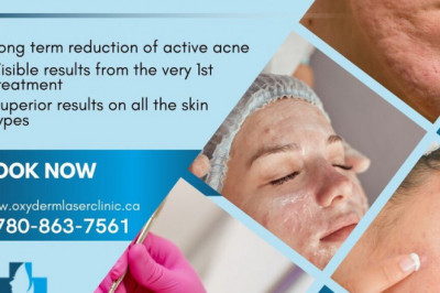 Acne Treatment Clinic in Alberta, Edmonton | Oxyderm Laser Clinic