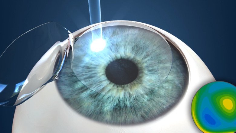 Global Custom LASIK Surgery Market expected to grow as ophthalmic disorders and technological advancements boost the market
