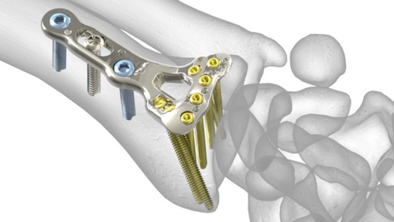 Global Radial Head Resection Implants Market Expansion 2030