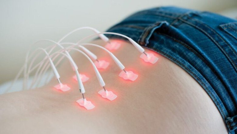 Global Acupuncture Lasers Market Segmentation Analysis