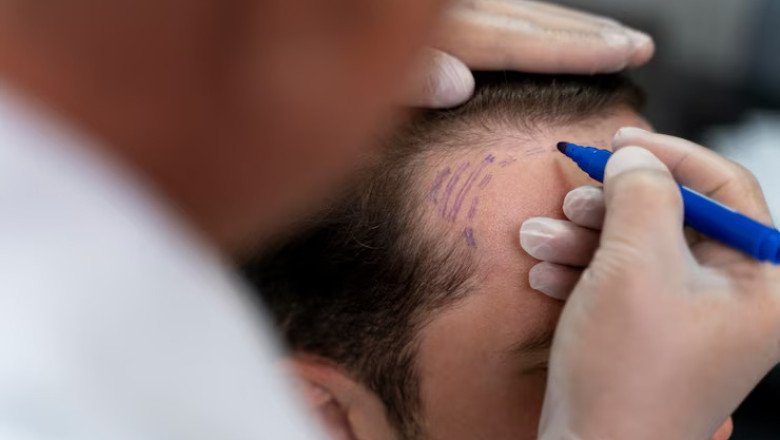 Hair transplant surgery: How to pay through easy no-cost EMIs
