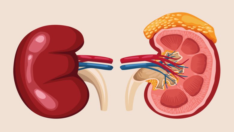 Kidney stone removal surgery in Bangalore: What you need to know