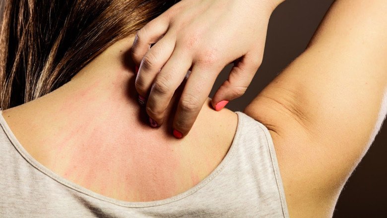 Global Eczema Therapeutics Market Forecast till 2030