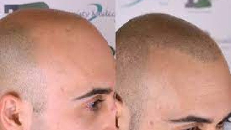 What is Scalp Trico pigmentation?