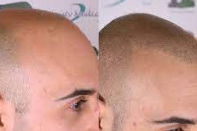 What is Scalp Trico pigmentation?