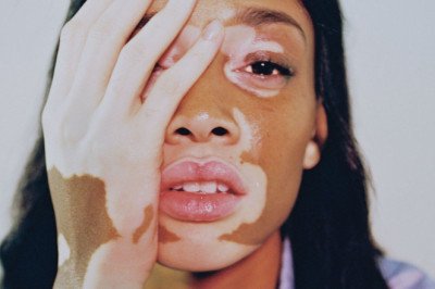 When Used Under The Supervision Of A Dermatologist, Vitiligo Drugs Are Generally Safe And Effective