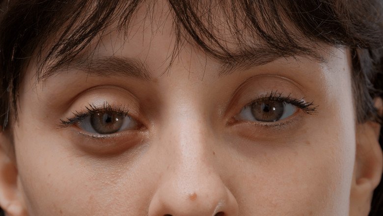 5 Best Cream For Dark Circles Under Eyes – An Unbiased Review