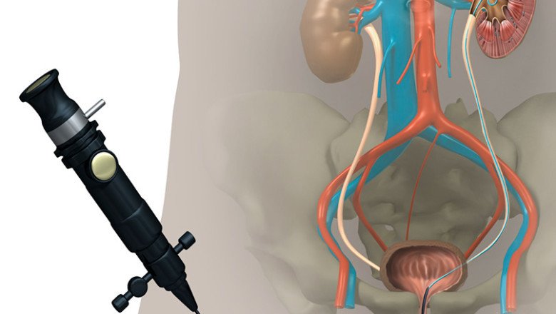 An Ureteral Stents Inserts A Soft, Hollow Tube Into The Urinary Tract For A Temporary Period Of Time