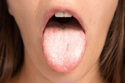 Candidiasis Market Trend, Forecast, Drivers, Restraints, Company Profiles and Key Players Analysis by 2027